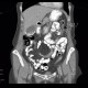 Porcelain gallbladder, calcification of gallbladder, cholecystolithiasis, gallstones: CT - Computed tomography