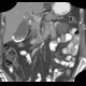 Porcelain gallbladder, calcification of gallbladder, cholecystolithiasis, gallstones: CT - Computed tomography