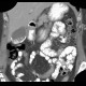 Porcelain gallbladder, calcification of gallbladder, cholecystolithiasis, gallstones: CT - Computed tomography