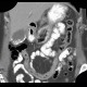 Porcelain gallbladder, calcification of gallbladder, cholecystolithiasis, gallstones: CT - Computed tomography