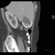 Porcelain gallbladder, calcification of gallbladder, cholecystolithiasis, gallstones: CT - Computed tomography