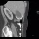 Porcelain gallbladder, calcification of gallbladder, cholecystolithiasis, gallstones: CT - Computed tomography