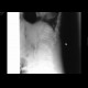 Compression of thoracic vertebra, osteoporosis: X-ray - Plain radiograph