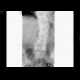 Compression of thoracic vertebra, osteoporosis: X-ray - Plain radiograph