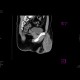 Inguinal hernia, laparoscopic repair, remained peritoneal sac with hematoma: CT - Computed tomography