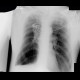 Postspecific changes in lung: X-ray - Plain radiograph