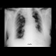 Postspecific changes: CT - Computed tomography