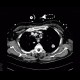 Postspecific changes in lung: CT - Computed tomography