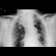 Postspecific changes: CT - Computed tomography