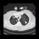 Postspecific changes in lung: CT - Computed tomography