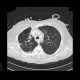 Postspecific changes in lung: CT - Computed tomography