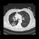 Postspecific changes in lung: CT - Computed tomography