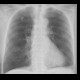 Postspecific nodule in lung: X-ray - Plain radiograph