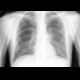 Postspecific changes: X-ray - Plain radiograph