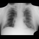 Fenestration of rib: X-ray - Plain radiograph
