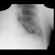 Fenestration of rib: X-ray - Plain radiograph