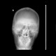 Craniotomy: X-ray - Plain radiograph