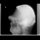 Craniotomy: X-ray - Plain radiograph