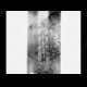 Chyme in bowel loops: X-ray - Plain radiograph