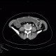 Crohn's disease, subtotal colectomy, ileosigmoid anastomosis: CT - Computed tomography