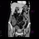 Crohn's disease, subtotal colectomy, ileosigmoid anastomosis: CT - Computed tomography