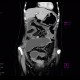 Crohn's disease, subtotal colectomy, ileosigmoid anastomosis: CT - Computed tomography