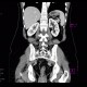 Crohn's disease, subtotal colectomy, ileosigmoid anastomosis: CT - Computed tomography