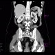 Crohn's disease, subtotal colectomy, ileosigmoid anastomosis: CT - Computed tomography