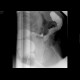 Post-inflammatory stenosis of the sigmoid colon: RF - Fluoroscopy