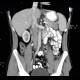 Postinflammatory changes of the tail of pancreas: CT - Computed tomography