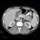 Postinflammatory changes of the tail of pancreas: CT - Computed tomography