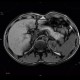 Postinflammatory changes of the tail of pancreas: MRI - Magnetic Resonance Imaging