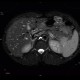 Postinflammatory changes of the tail of pancreas: MRI - Magnetic Resonance Imaging