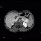 Postinflammatory changes of the tail of pancreas: MRI - Magnetic Resonance Imaging