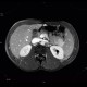 Postinflammatory changes of the tail of pancreas: MRI - Magnetic Resonance Imaging