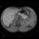 Postinflammatory changes of the tail of pancreas: MRI - Magnetic Resonance Imaging