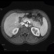 Postinflammatory changes of the tail of pancreas: MRI - Magnetic Resonance Imaging