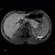 Postinflammatory changes of the tail of pancreas: MRI - Magnetic Resonance Imaging