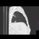 Accessory fissure: CT - Computed tomography