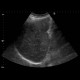 Primary sclerosing cholangoitis, sludge: US - Ultrasound