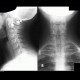 Processus megatransversus: X-ray - Plain radiograph