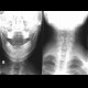 Processus megastransversus, C7: X-ray - Plain radiograph