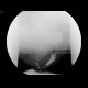 Rectal prolapse: RF - Fluoroscopy