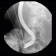 ERCP, migration of duodenobiliary drain: RF - Fluoroscopy
