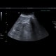 Edema of perinephric fat: US - Ultrasound