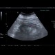 Edema of perinephric fat: US - Ultrasound