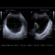 Prostatic hyperplasia, trabecular hypertrophy of urinary bladder: US - Ultrasound