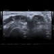 Baker's cyst, rupture: US - Ultrasound