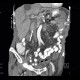 Malposition and migration of duodenobiliary stent, before removal: CT - Computed tomography