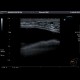 Breast implant: US - Ultrasound